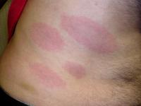 Lyme rashes satellite like